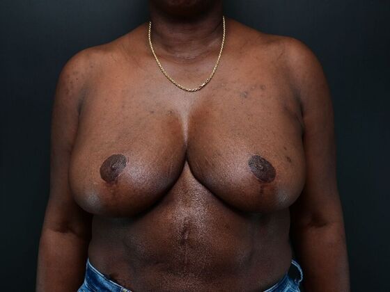 Breast Reconstruction: Case 4 - After