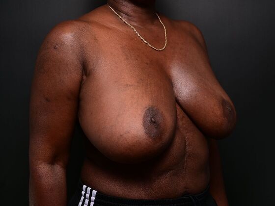 Breast Reconstruction Case 4 - Before