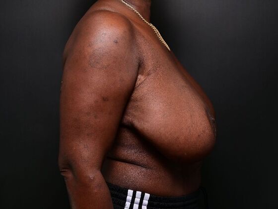 Breast Reconstruction: Case 4 - Before