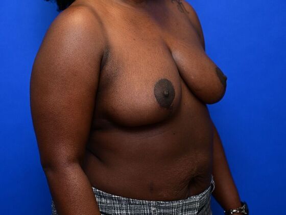 Breast Reconstruction Case 7 - After