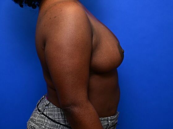 Breast Reconstruction: Case 7 - After