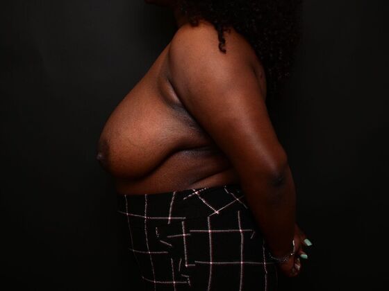 Breast Reconstruction: Case 7 - Before