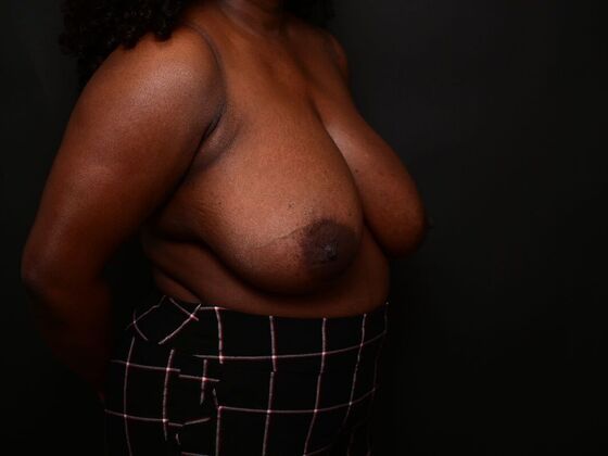 Breast Reconstruction Case 7 - Before