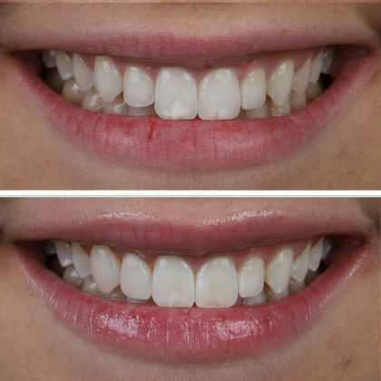 No Prep Porcelain Veneers Hannah - Before