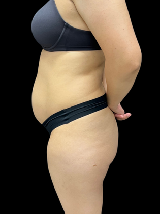Liposuction Liposuction 18 - Before