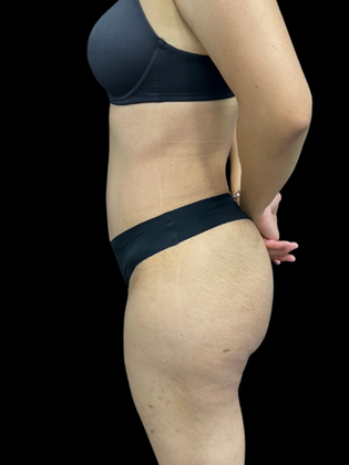 Liposuction Liposuction 18 - After