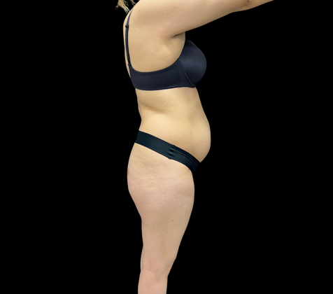 Liposuction: Case 10 - Before