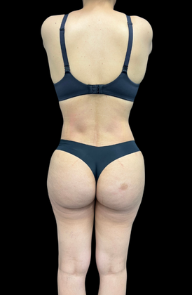 Liposuction: Case 10 - After