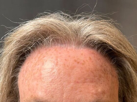 Hairline Feminization Case 2 - Before