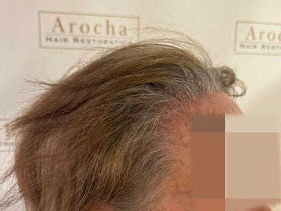 Hairline Feminization: Case 2 - After