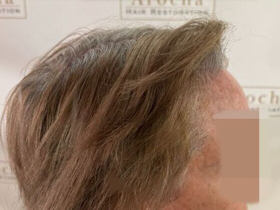 Hairline Feminization: Case 2 - After