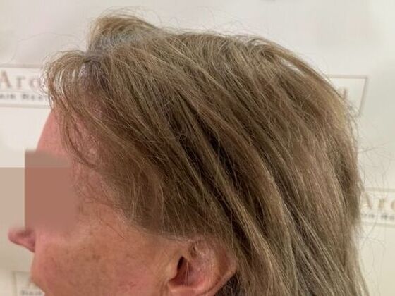 Hairline Feminization: Case 2 - After