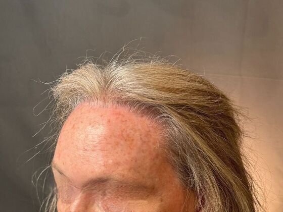 Hairline Feminization: Case 2 - Before