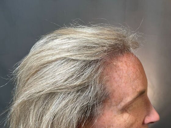 Hairline Feminization: Case 2 - Before