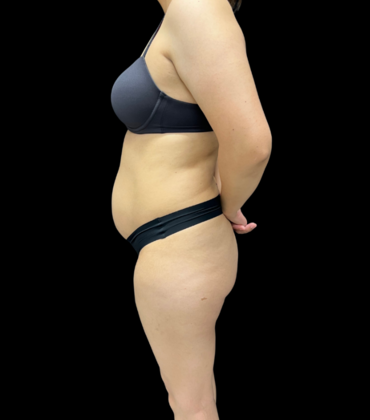 Brazilian Butt Lift: Case 8 - Before