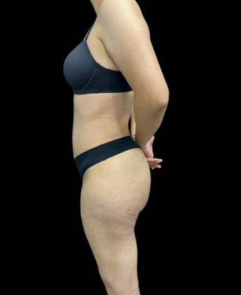 Brazilian Butt Lift: Case 8 - After