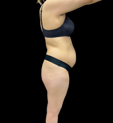 Brazilian Butt Lift: Case 8 - Before