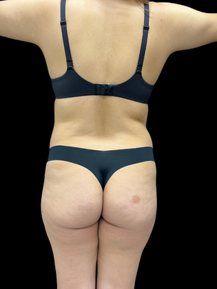 Brazilian Butt Lift Case 8 - Before