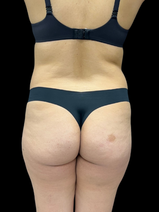 Brazilian Butt Lift BBL 1 - Before