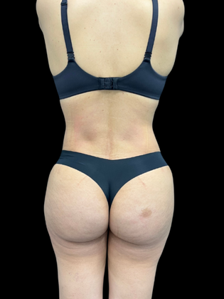 Brazilian Butt Lift Case 8 - After