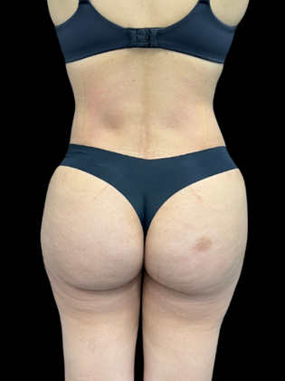 Brazilian Butt Lift BBL 1 - After