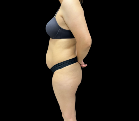 Tummy Tuck Case 6 - Before