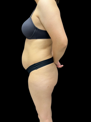 Tummy Tuck Tummy Tuck 1 - Before