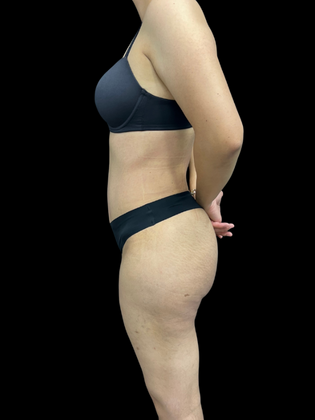 Tummy Tuck Tummy Tuck 1 - After