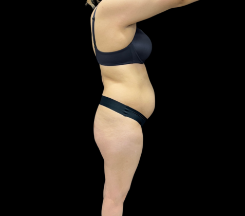 Tummy Tuck: Case 6 - After