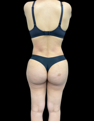 Tummy Tuck: Case 6 - After