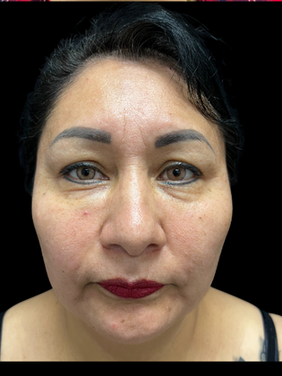 Blepharoplasty Case 1 - Before