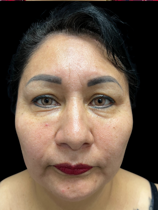 Blepharoplasty Blepharoplasty 1 - Before