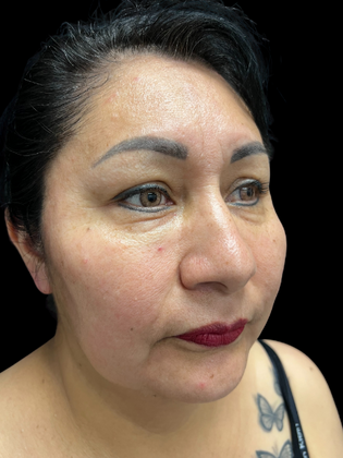 Blepharoplasty: Blepharoplasty 1 - After