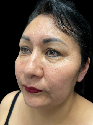 Blepharoplasty: Blepharoplasty 1 - Before