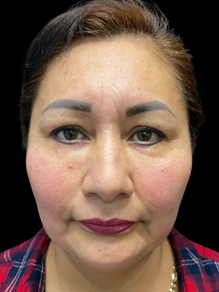 Blepharoplasty Blepharoplasty 1 - After
