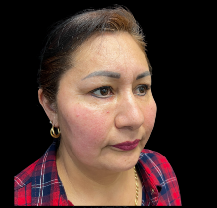 Blepharoplasty: Case 1 - Before