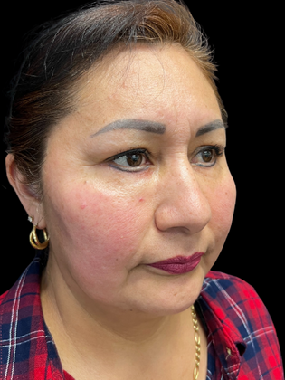 Blepharoplasty: Blepharoplasty 1 - Before
