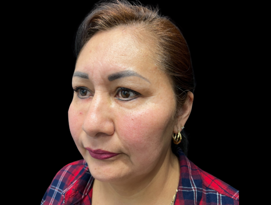 Blepharoplasty: Case 1 - After