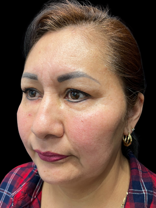 Blepharoplasty: Blepharoplasty 1 - After