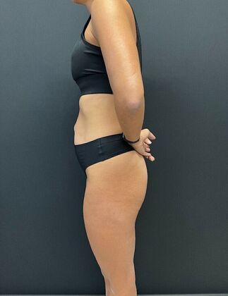 Tummy Tuck: Case 7 - Before