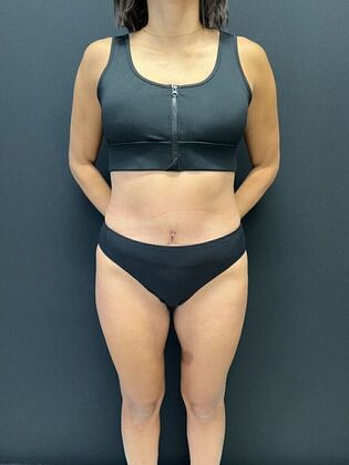 Tummy Tuck Case 7 - After