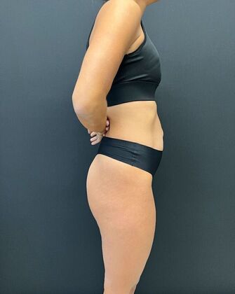 Tummy Tuck: Case 7 - Before