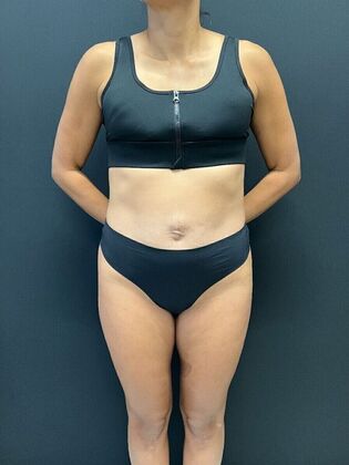 Tummy Tuck Case 7 - Before
