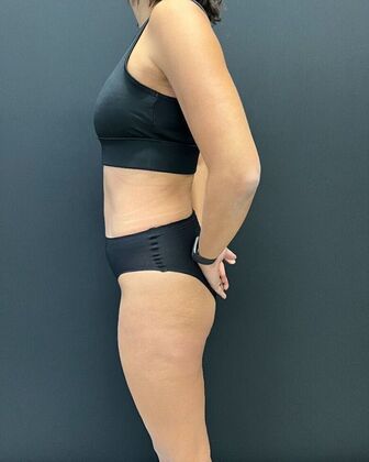 Tummy Tuck: Case 7 - After