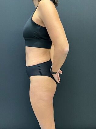 Tummy Tuck Tummy Tuck 7 - After