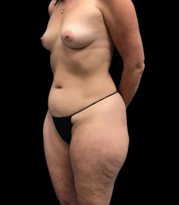 Tummy Tuck: Case 8 - Before