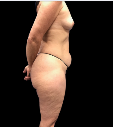 Tummy Tuck: Case 8 - Before