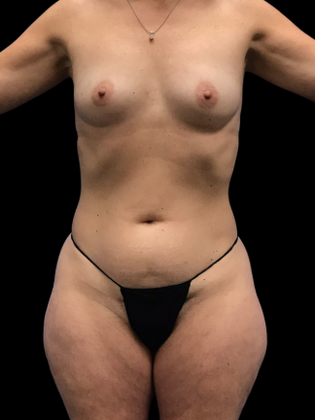 Tummy Tuck Case 8 - Before