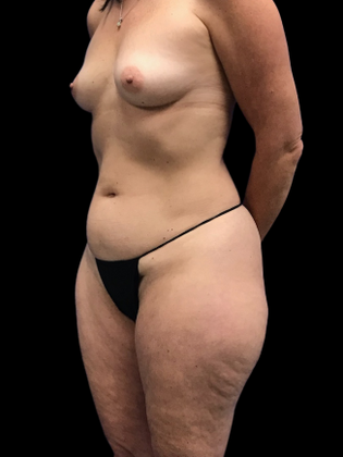 Liposuction: Liposuction 9 - Before