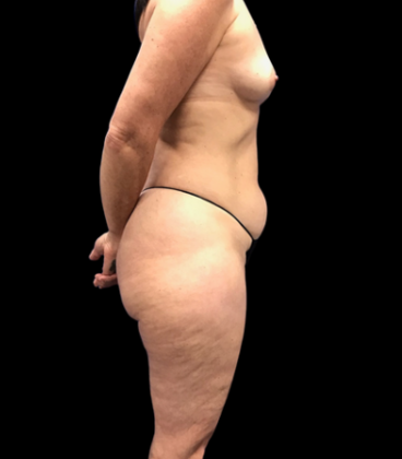 Liposuction: Case 11 - Before